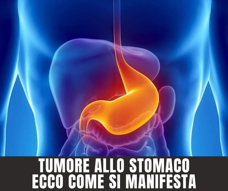 Tumore allo stomaco fattori di rischio, sintomi, diagnosi e cura Bazzing Tumore allo stomaco fattori di rischio, sintomi, diagnosi e cura Bazzing